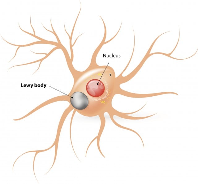 Lewy body disease Lewy body disease